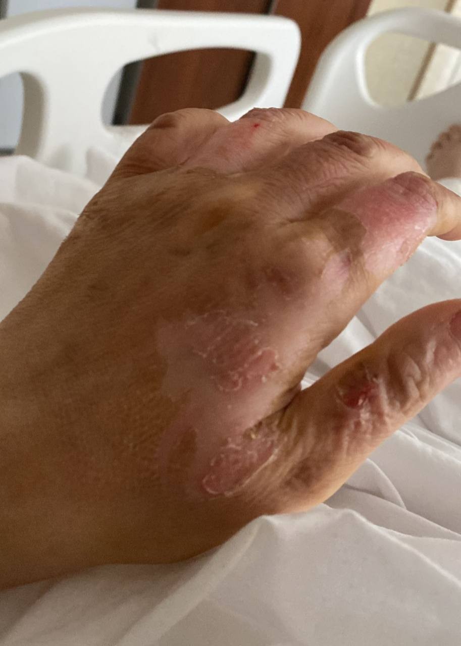 Gec klubundakı partlayışda xəsarət alan Aysel baş verənlərlə bağlıgörün nə danışıb - FOTOLAR