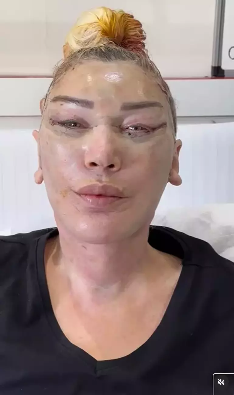 Məşhur müğənninin bacısı tanınmaz halda- Plastik əməliyyat etdirib görün nə hala düşdü